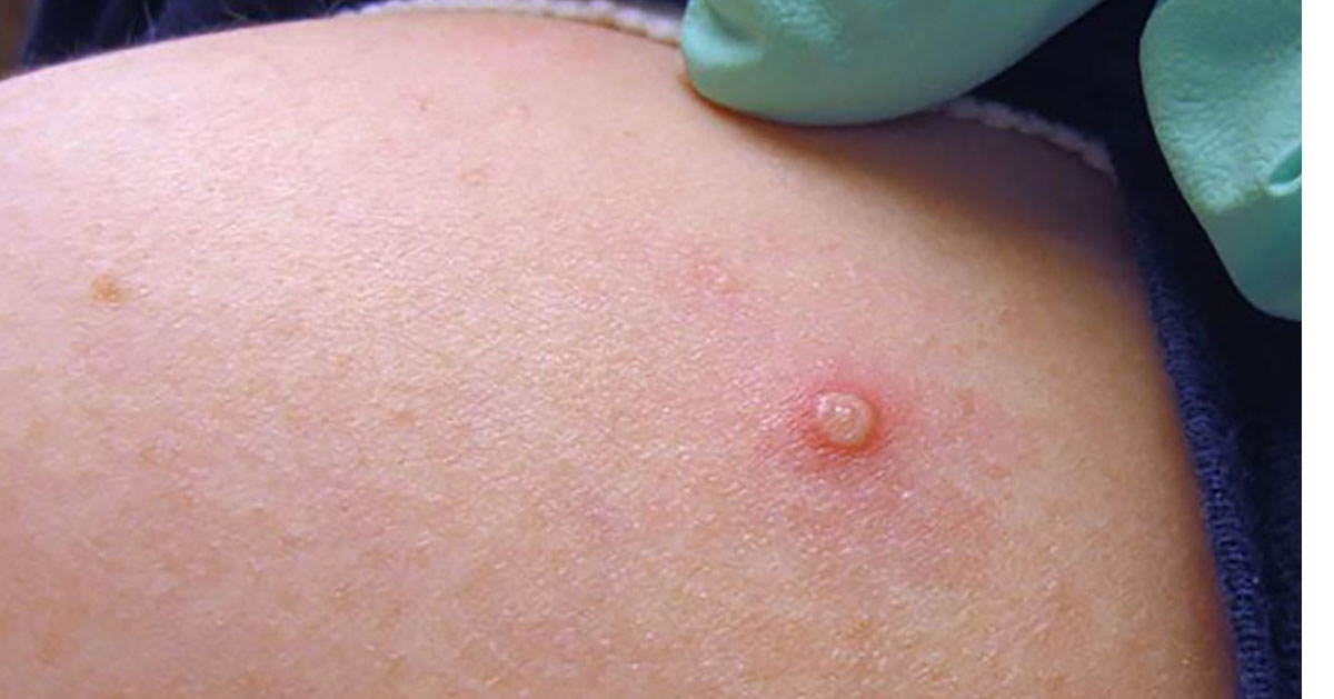 monkey pox